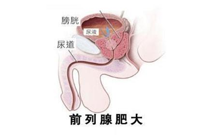 治前列腺增生特效药 什么是前列腺增生