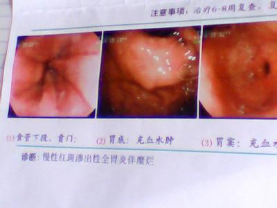 红斑渗出性胃炎 什么是红斑渗出性胃炎 红斑渗出性胃炎简介
