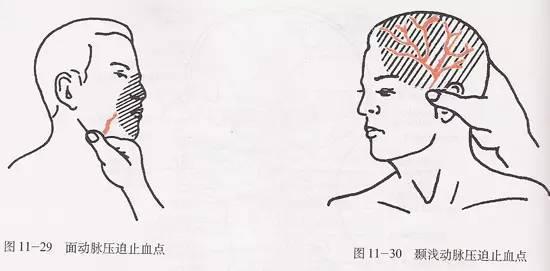 动脉压迫止血器 压迫止血方法