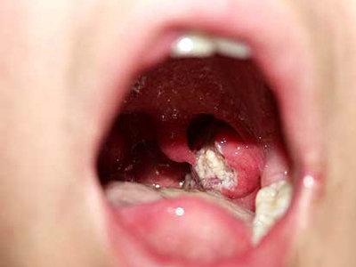 上火牙龈肿痛怎么办 牙龈上火的10个食疗方