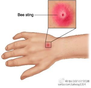 蜂蜇伤 蜂蜇伤的急救方法