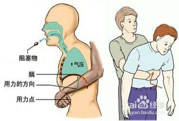 呼吸道异物 异物吸入呼吸道怎么办