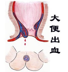 屁多,大便血怎么回事 大便出血是怎么回事啊