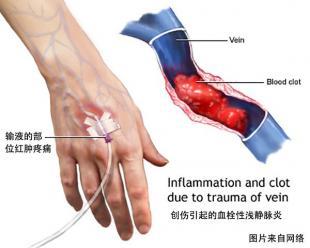 输液对血管的危害 长期输液对血管的危害大吗