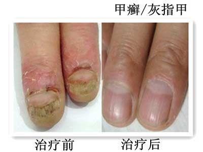 灰指甲的病因 灰指甲的常见病因