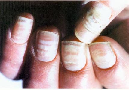 灰指甲的初期症状 怎样预防灰指甲