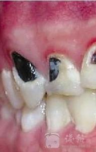 牙齿泡在可乐里 传可乐泡10天牙齿会融化 实验：牙齿泡15天变质