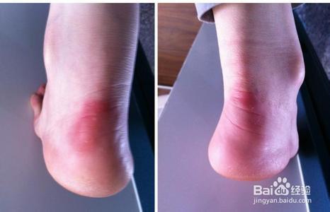 足跟痛的治疗方法 脚后跟疼是什么原因