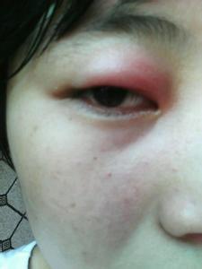 上眼皮红肿疼痛怎么办 眼睛红肿疼痛怎么办