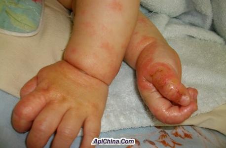 起过湿疹的部位容易红 哪些部位容易发生湿疹