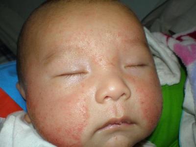 宝宝湿疹反复怎么办 宝宝湿疹了该怎么办