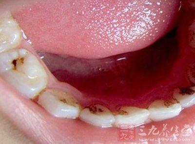 孕妇牙根肿痛有偏方吗 孕妇牙根肿痛吃什么