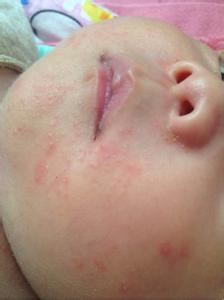 婴儿烂嘴角的治疗方法 婴儿烂嘴角怎么治疗
