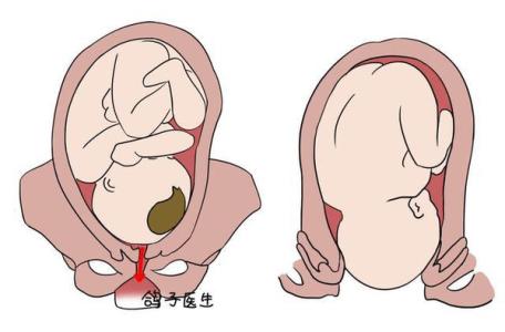 剖腹产和顺产哪个更痛 顺产和剖腹产哪种更痛