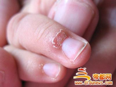 指甲周围长倒刺 指甲周围长倒刺是缺维生素吗（推荐）