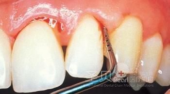 什么原因诱发白斑病 什么原因会诱发牙周炎