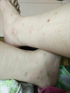 蚊子咬的疤痕怎么消 蚊子咬的疤怎么去?