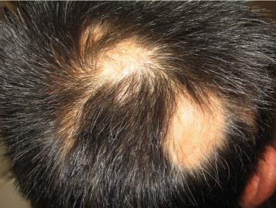 男性斑秃原因及治疗 斑秃是什么原因