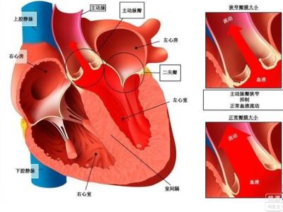 风湿性心脏病早期 风湿性心脏病的症状