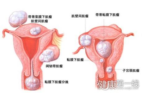 子宫肌瘤初期什么症状 子宫肌瘤有哪些症状