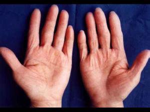 手癣是什么症状 手癣的发生机制是什么