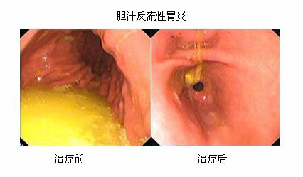 胆汁反流胃炎怎么调理 胆汁反流性胃炎有什么症状