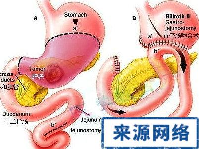 胆汁反流性胃炎 什么原因会引起胆汁反流性胃炎