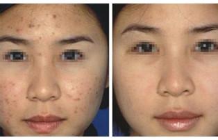 脸部痤疮最佳治疗方法 痤疮的治疗方法
