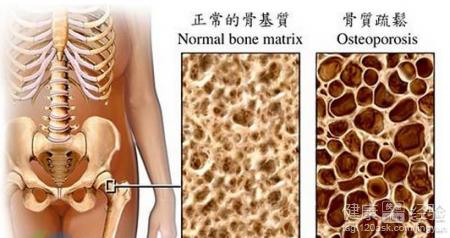骨质疏松的治疗方法 骨质疏松吃什么好呢