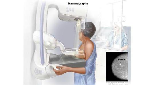 乳腺癌早期筛查 定期筛查有助早期发现判断乳腺癌
