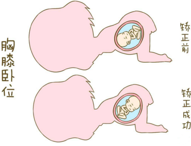 怀孕胎位不正怎么睡觉 怀孕胎位不正怎么办