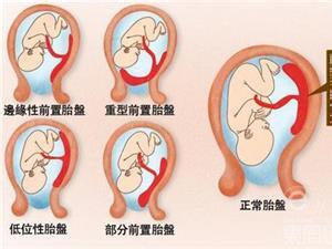 3个月胎盘位置低怎么办 胎盘位置低的原因