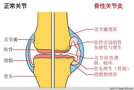 世界关节炎日 10.12世界关节炎日的由来