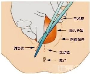 会阴侧切后遗症 会阴侧切后要如何养护