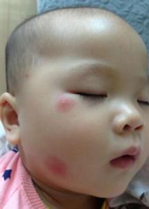 宝宝被蚊子咬到满脸包 宝宝被蚊子叮了起包怎么办