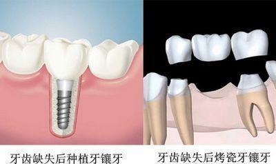 种植牙多大都可以嘛 种植牙和镶牙有什么区别