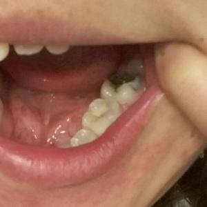 儿童坏牙怎么治疗 坏牙怎么治疗