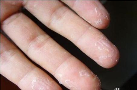 手脱皮是缺什么维生素 手脱皮是什么原因引起的