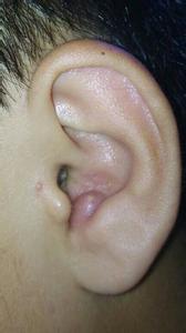 耳朵里痘痘爆了怎么办 耳朵里为什么会长痘痘