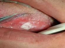 口腔白斑病的症状 口腔白斑病症状