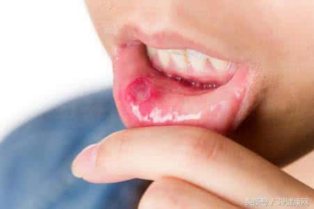 口腔溃疡吃什么药好使 口腔溃疡吃什么好得快？