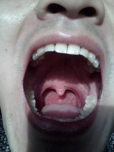严重的口腔疾病有哪些 能从口腔发现的六种严重疾病