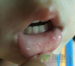 防治口腔溃疡 儿童口腔溃疡的防治
