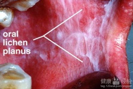 口腔扁平苔藓症状图片 口腔扁平苔藓症状