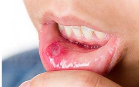 口腔溃疡治疗小窍门 口腔溃疡的原因和治疗方法