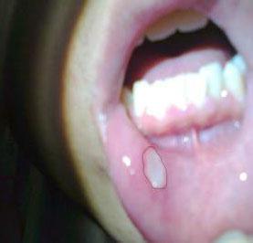口腔溃疡症状表现 口腔溃疡的症状表现