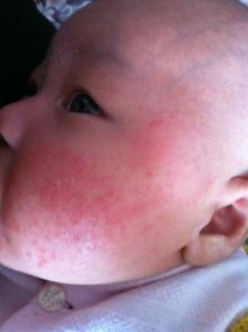 宝宝发烧时出疹子 孩子发烧又出疹子当心4种病