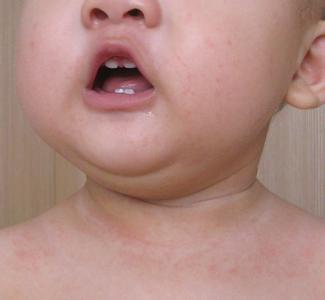 婴儿发烧后出红疹图片 宝宝发烧后出疹子怎么办