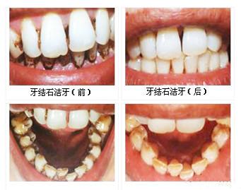 洗牙对牙齿有影响吗 洗牙对牙齿有什么影响