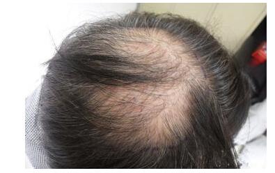 头顶脱发的治疗方法 防止头顶脱发的方法